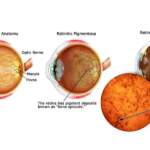Stargardt’s Disease Treatment