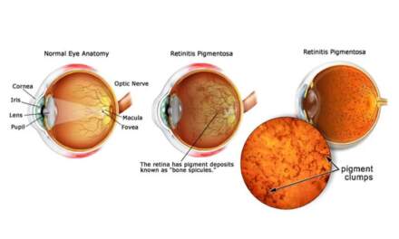 Stargardt’s Disease Treatment