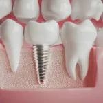 How Implant Dentistry Blends Aesthetics With Durability