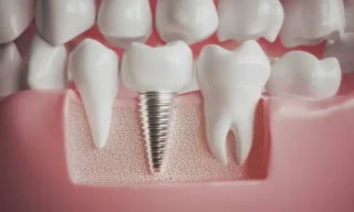 How Implant Dentistry Blends Aesthetics With Durability